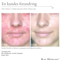Hh 3*Hyaluronic Acid 3*Peptides