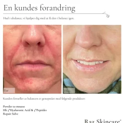Hh 3*Hyaluronic Acid 3*Peptides