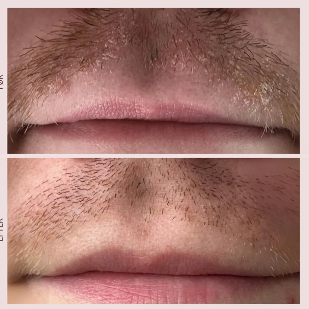 Skæl Serum